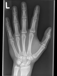 Röntgenbild Hand